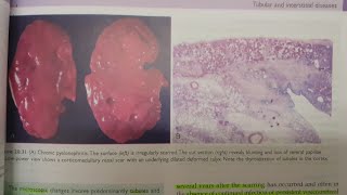 Chronic Pyelonephritis  SPECIAL PATHOLOGY [upl. by Lexerd]