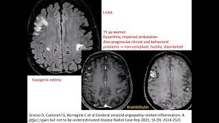 69 ICAA and ABRA CAA related inflammation amyloid beta related angiitis encephalopathy elderly [upl. by Nyroc70]