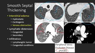 Septal Thickening [upl. by Nnylharas]