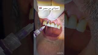 Caries removal and rehabilitation of the tooth phonk remix music genshinimpact asmrdentist [upl. by Ivers]