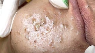 Big Cystic Acne Blackheads Extraction Blackheads amp Milia Whiteheads Removal Pimple Popping  4809 [upl. by Ytsanyd]