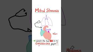 Mitral Stenosis MS  Valvular Heart Diseases VHD Part 2…anatomy mbbs cardio cardiology [upl. by Ymerej]