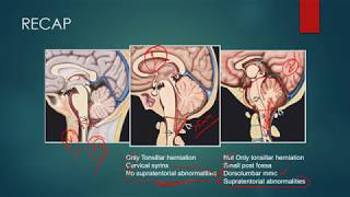 CHIARI MALFORMATIONS RADIOLOGY CT MRI [upl. by Plath]