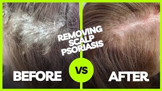 Removing Plaque Scalp Psoriasis  Using The AntiFungal Bundle myhappyscalpcom [upl. by Ahseem]