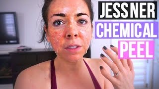 NIKKI GETS A NEW FACE Jessner Chemical Peel Review Before and After [upl. by Etnovad]