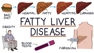 Understanding NonAlcoholic Fatty Liver Disease [upl. by Ayotyal]