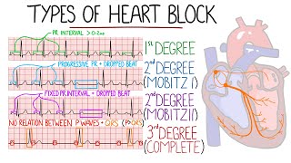 Heart Blocks Made Easy  1st 2nd Mobitz 1Wenckebach amp Mobitz 2 3rd Complete  with ECGs [upl. by Albertson]