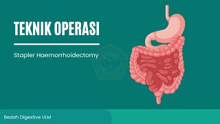 Stapler Haemorrhoidectomy by Dr dr Agung Ary Wibowo SpB SubspBDK [upl. by Haynor]