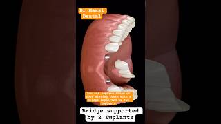 Dental Bridge Supported by 2 IMPLANTS [upl. by Locin298]