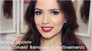 Invisalign  Attachments Removal amp Refinements [upl. by Fredericka406]