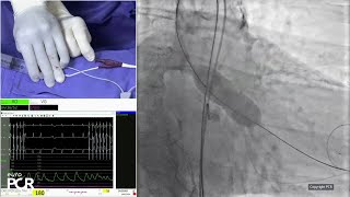 Align for the future with nextgeneration balloon expandable transcatheter heart valve technology [upl. by Atiluj]