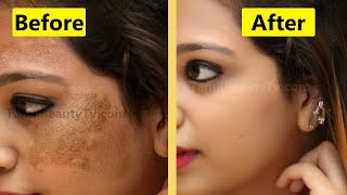 How to Remove Skin pigmentation from face  Beauty Tips in Tamil [upl. by Yrret]