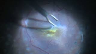 Epi Retinal gliosis Removal [upl. by Pompea]