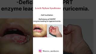 Lesch Nyhan Syndrome High yield Topic  🔥🔥💯💯 fmge shorts [upl. by Notna]