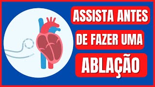 6 DICAS IMPORTANTES ANTES DE FAZER ABLAÇÃO POR CATETER DE ARRITMIAS CARDÍACAS  DR FELIPE SOUZA [upl. by Daisey]