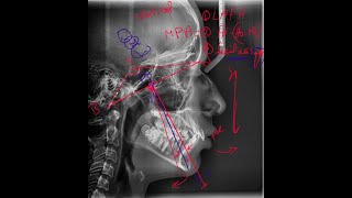 13 McNamara Analysis Cephalometric Analysis [upl. by Bonni]