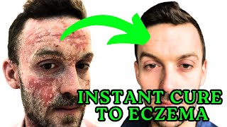 The Best amp Most Effective Remedy for Eczema [upl. by Zirkle786]