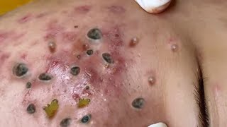 Big Cystic Acne Blackheads Extraction Blackheads amp Milia Whiteheads Removal Pimple Popping [upl. by Jamaal]