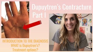 What Is Dupuytrens Contracture A Basic Introduction [upl. by Ettenal]