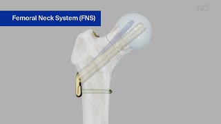 Femur Neck—Fracture 31B—Stabilization Using the Femoral Neck System FNS [upl. by Letsirhc]