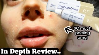 1 WEEK OF TRETINOIN 1 TEST CLEARING ACNE SCARS FAST The results [upl. by Chatav]