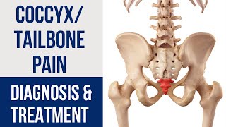 CoccyxTailbone Pain Diagnosis amp Treatment [upl. by Ardnauq]