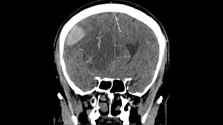 Brain herniation  subphalcine  due to intracranial haemorrhage CT findings [upl. by Maighdlin]