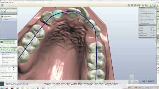 3Shape OrthoAnalyzer 2010 Preview [upl. by Ailemaj]