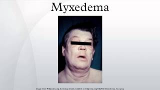 Myxedema [upl. by Seabrooke]