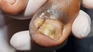 O MAIOR VÍDEO DO CANAL UNHA INFECCIONADA A 5 MESES podologomaurelio podologiahumanizada [upl. by Ulland488]