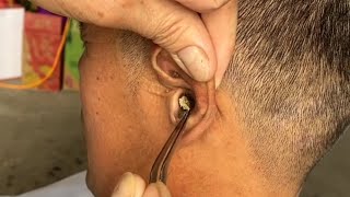 Removing ear blockage use manual tools [upl. by Dinerman363]