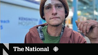 How a fleshrotting ‘zombie drug’ is complicating the overdose crisis [upl. by Ahse]