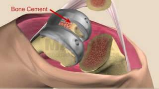 Total Knee Replacement [upl. by Campney887]