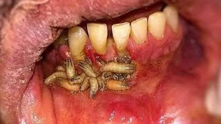 MYIASIS  Infection from flies  Management  Dr Zona khalid [upl. by Denney]