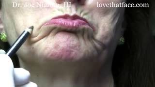 Botox Injection to DAO corner of mouth by Dr Joe Niamtu III [upl. by Larson424]