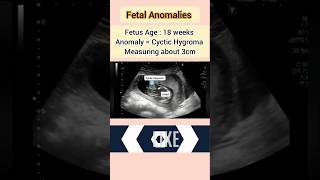 Fetal Anomaly ultrasound cyctic Hygromapregnancyultrasound medical baby [upl. by Htirehc173]