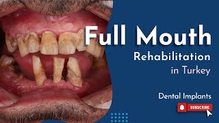 Full Mouth Rehabilitation  Dental Implants in Istanbul TURKEY [upl. by Atela]