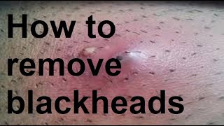 how are blackheads removed [upl. by Emanuel301]