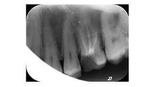 A quick way to locate the root apex in unclear radiographs [upl. by Editha510]