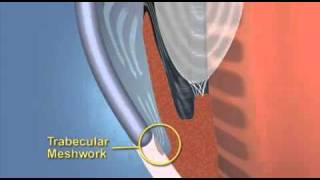 Primary Angle Closure Glaucoma Explained With Animation [upl. by Corneille]