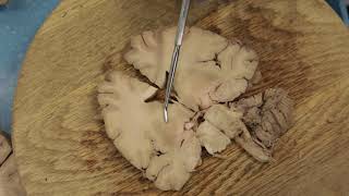 Coronal Brain Dissection [upl. by Nanny]