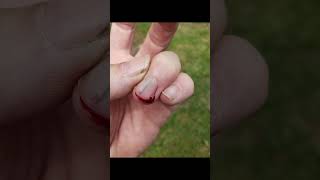 Emergency First Aid  Removing a splinter from under a fingernail [upl. by Oberheim]