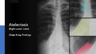 Atelectasis Right Lower Lobe Explanation of Chest Xray Findings [upl. by Niamrahc]