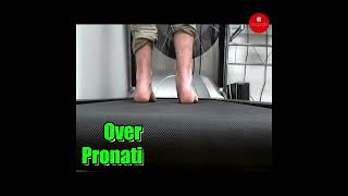 Discover the secrets of Over Pronation in our latest video Stay informed stay healthy [upl. by Idalia101]