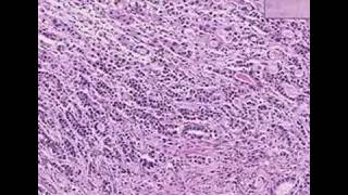 Histopathology StomachAdenocarcinoma [upl. by Kimball470]