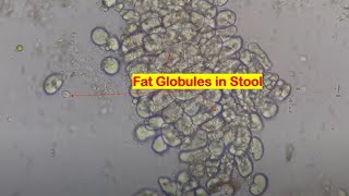 Fat globules in Stool Microscopy [upl. by Tower]