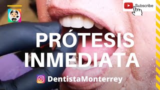 Prótesis DENTAL INMEDIATA 👅 PostExodoncia Parte1 [upl. by Idnem926]