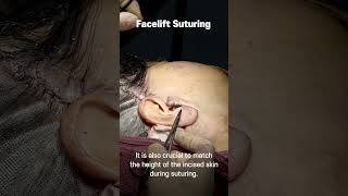 Facelift Suturing plasticsurgerykorea dasipiumplasticsurgery facelift suturing kwakminho [upl. by Baum354]