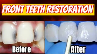 How to Fill Front Teeth Cavities with Dental Filling Procedure cavity removal dentalfilling vidiq [upl. by Auof]