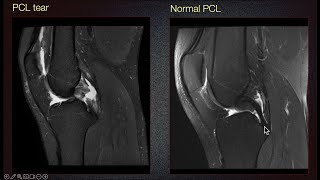 Sports Medicine Case 29 16yearold male When the MRI does not tell the whole story [upl. by Arlan840]